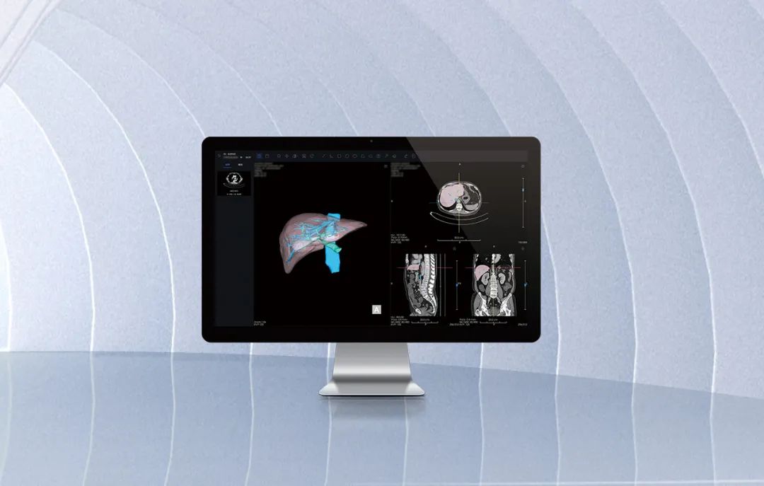 北京市首款！SBOBET利记医疗自主研发的AI+肝脏CT影像处置软件获批上市！